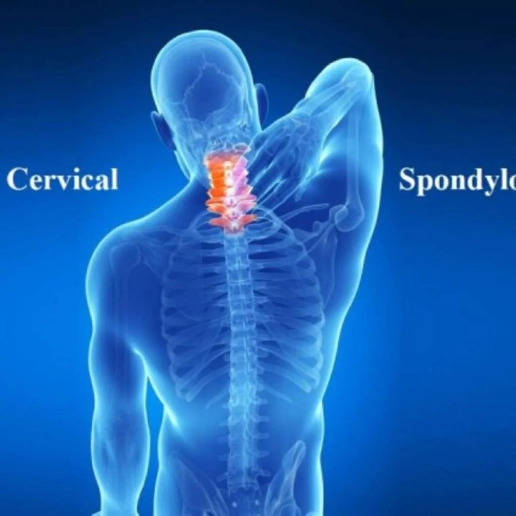 Cervical Spondylitis